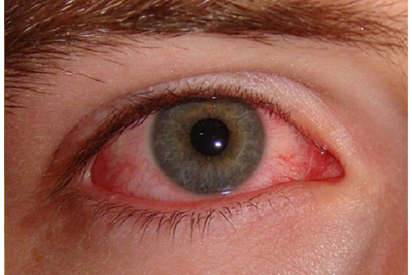 infección ameba de ojo