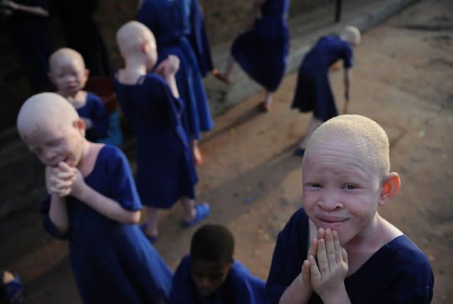 albinos-tanzania-11