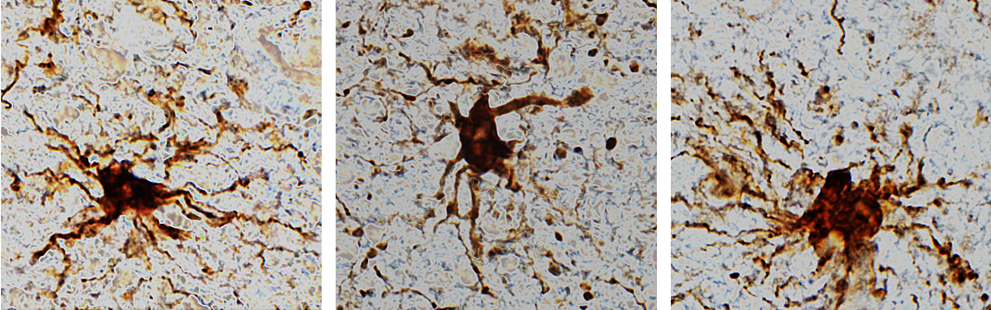 Los genes zombis del cerebro se identificaron luego de estudios en tejidos cerebrales donados.