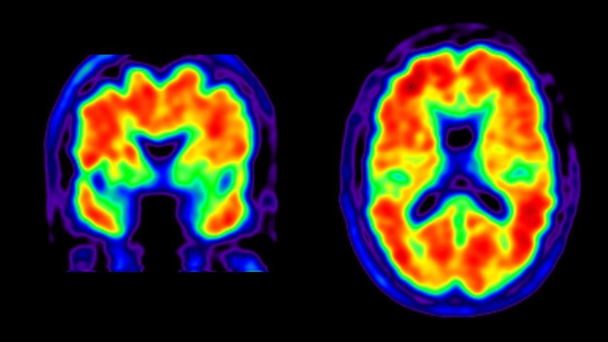 Una nueva forma de estudiar trastornos cerebrales involucra rayos gamma.