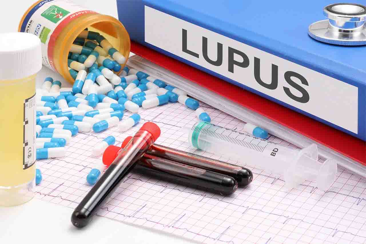 lupus es una enfermedad autoinmune