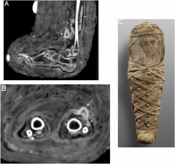 El hallazgo de la momia egipcia de un infante trajo un curioso descubrimiento.