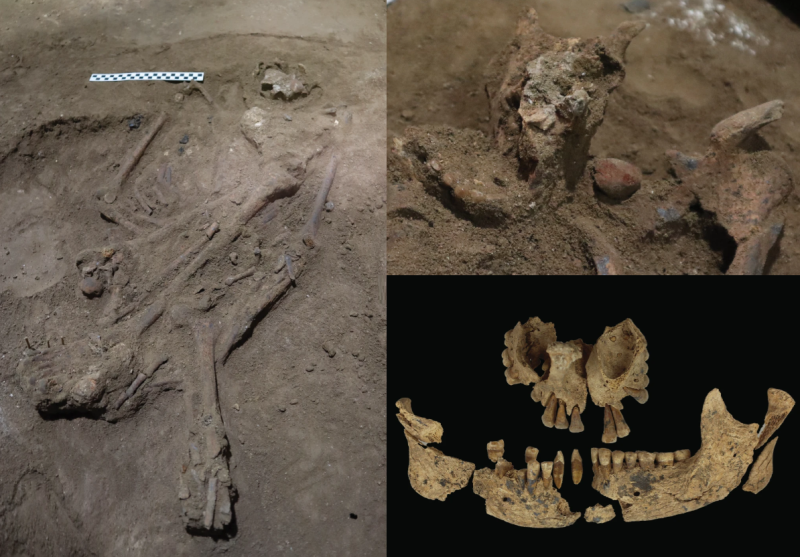 La primera amputación de la historia dejó rastros a los arqueólogos.