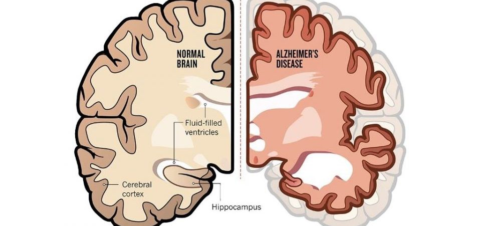 El alzheimer es una enfermedad que produce un profundo daño cerebral.