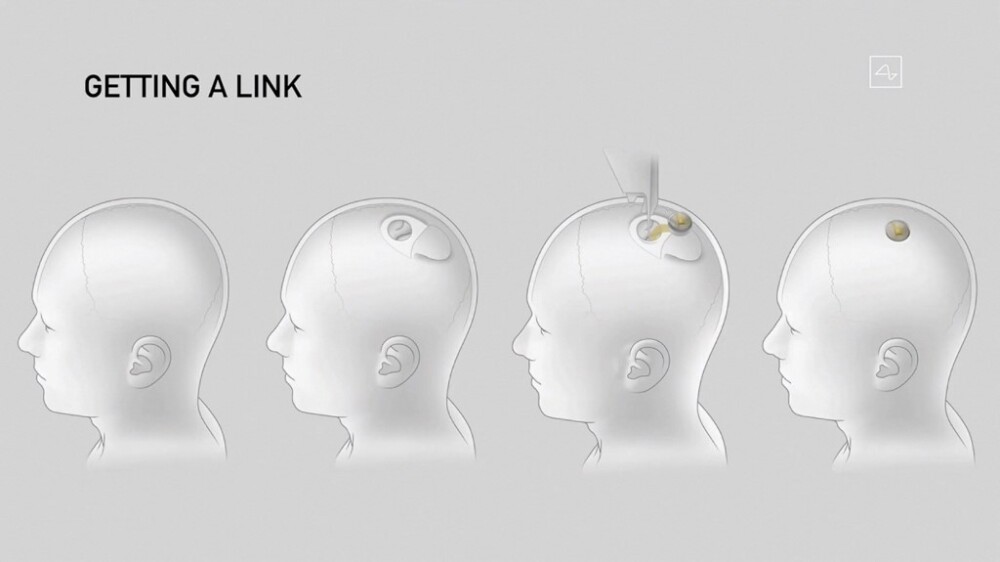 El primer implante de un chip en un cerebro humano lo hizo Neuralink.