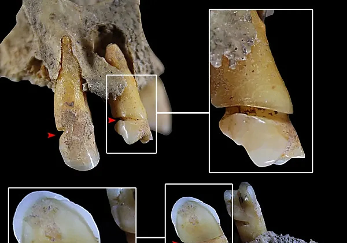 Las marcas en los dientes muestras un trabajo repetitivo.