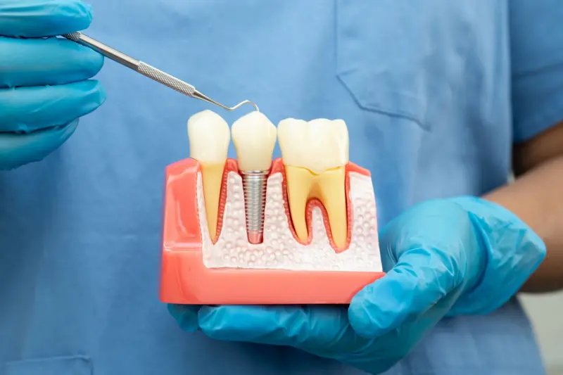 Es una alternativa para quienes han perdido piezas dentales.